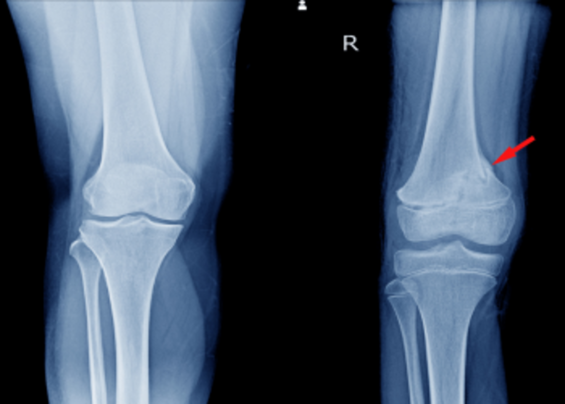 Total Knee replacement surgery