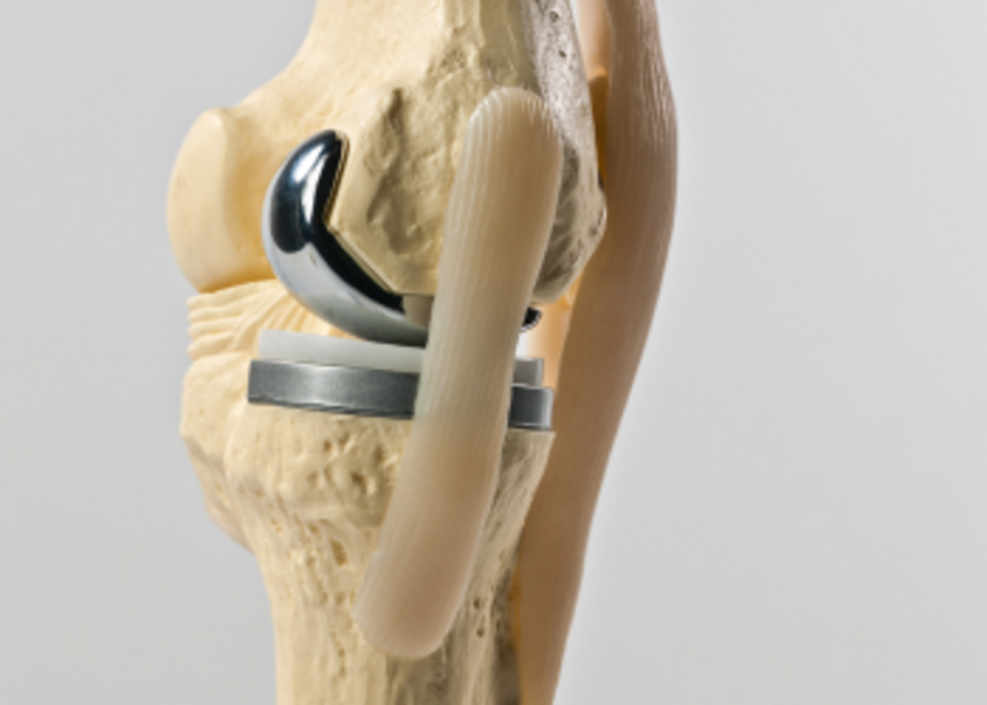 ⁠Partial Knee Replacement surgery