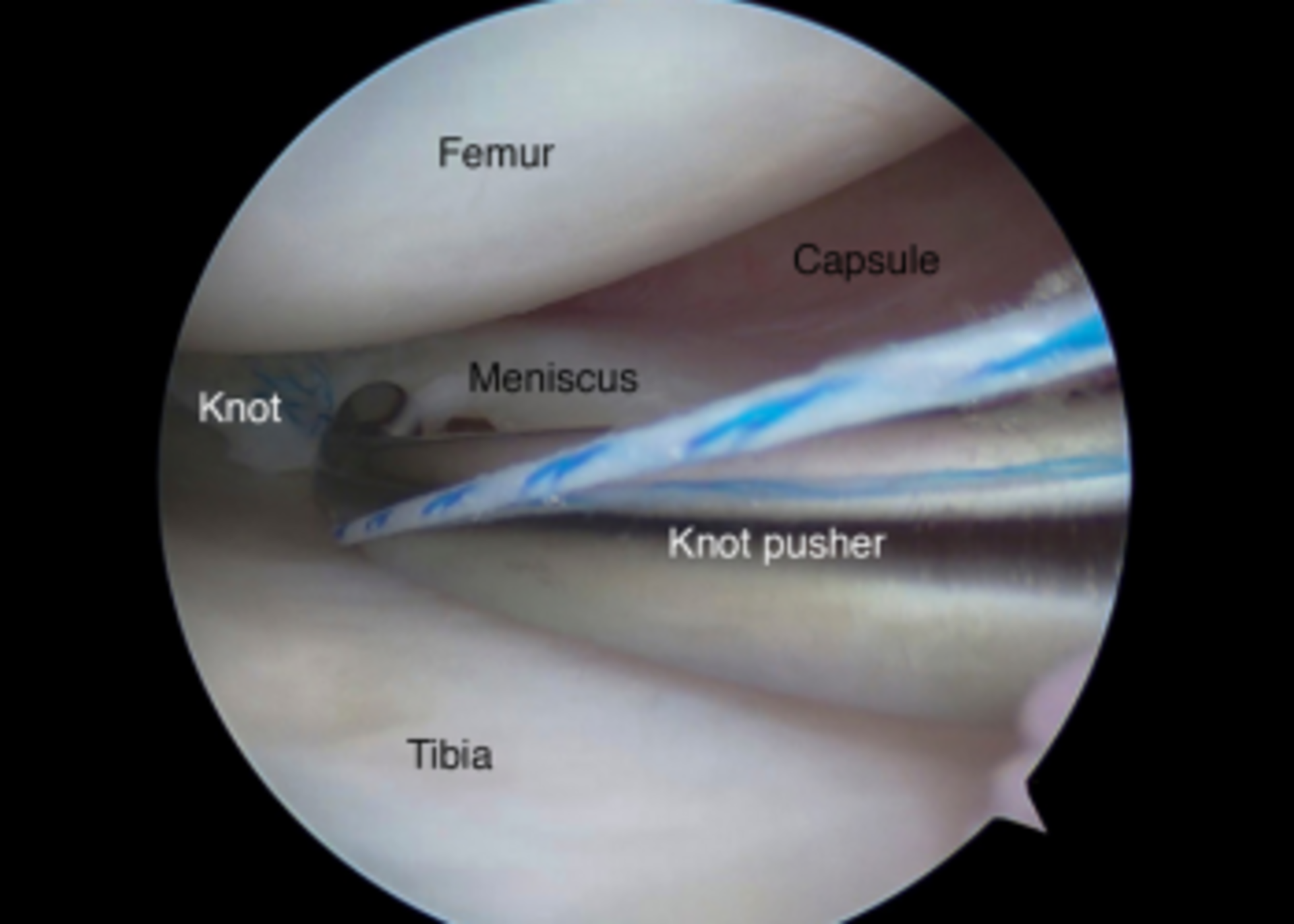 Meniscal Repair